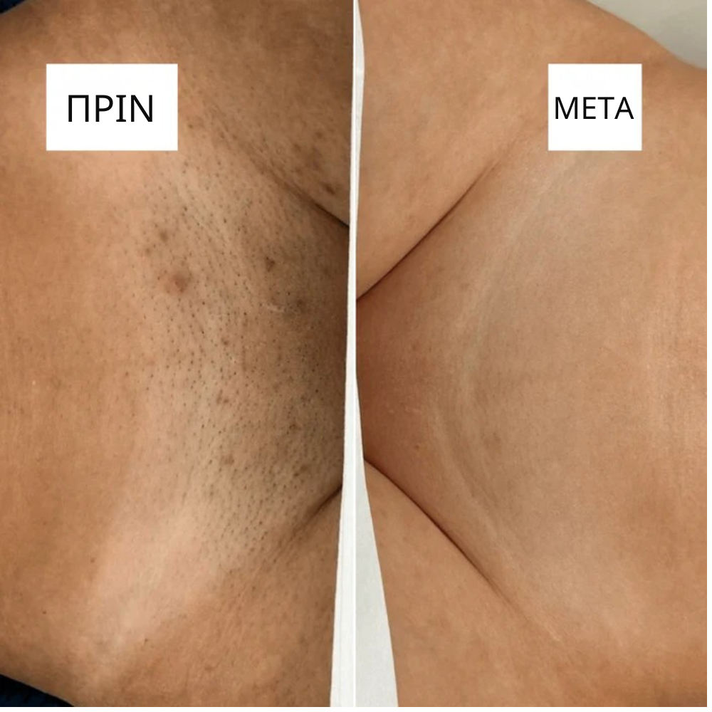 Αυθεντικό Ξυραφάκι – Προσωρινά 10 ΔΩΡΕΑΝ ανταλλακτικές λεπίδες