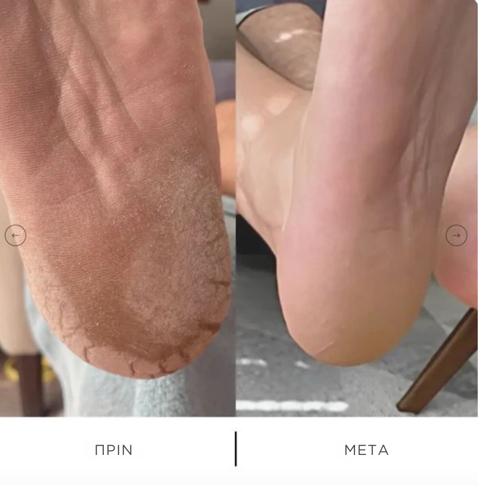 SOLEVA™ Επαγγελματικό Αφαιρετικό Κάλων