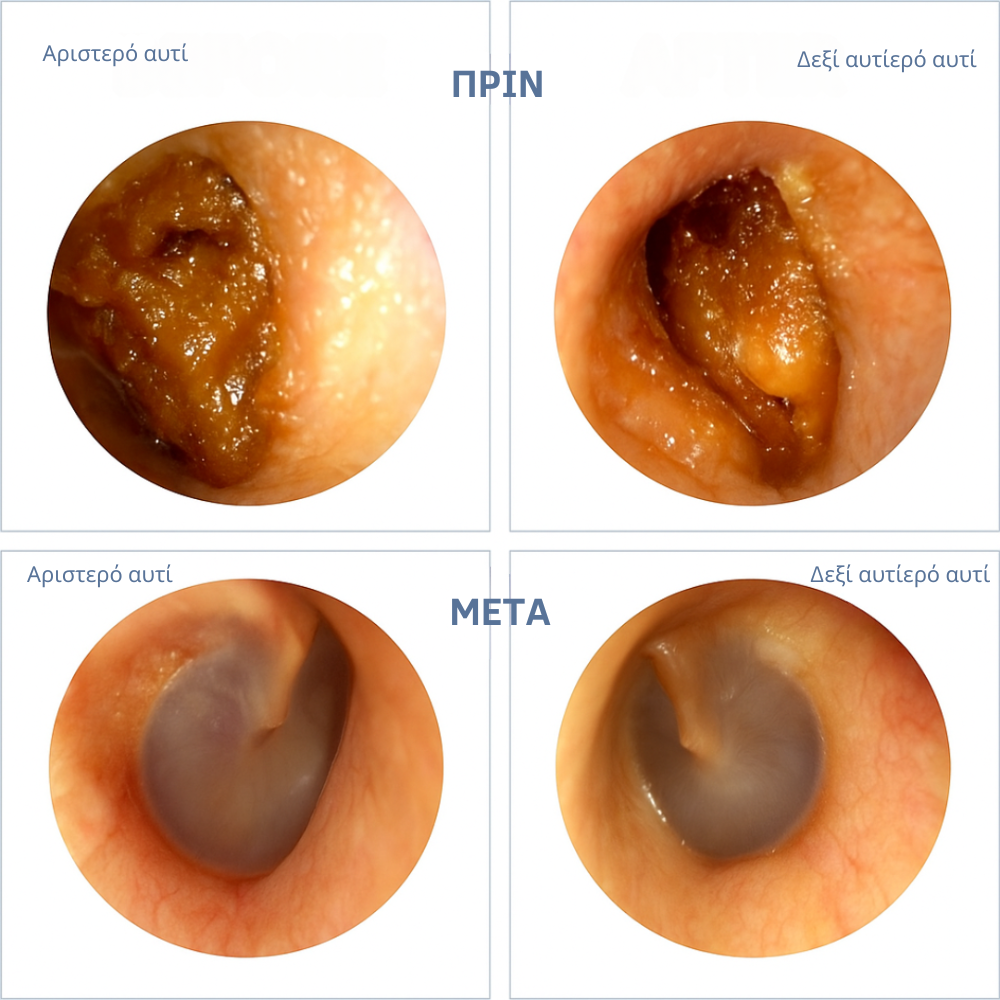 CleanEar Pro – Έξυπνος καθαρισμός αυτιών με προηγμένη τεχνολογία